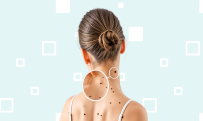 Бесплатный прием дерматолога, хирурга при удалении кожных новообразований